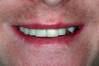 veneers_london_after
