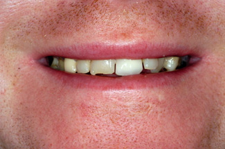 veneers_london_before