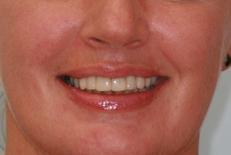 After Dental Crowns Treatment