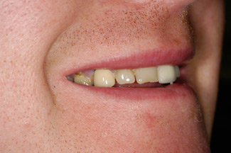 veneers_london_before