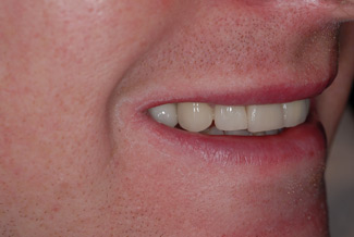 veneers_london_after
