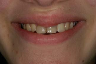 Dental Crown London Treatment Before