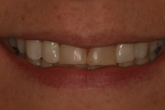 veneers_london_before