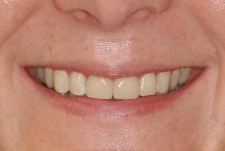 veneers_london_after