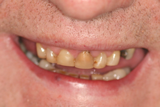 Dental Crown in London Treatment Before