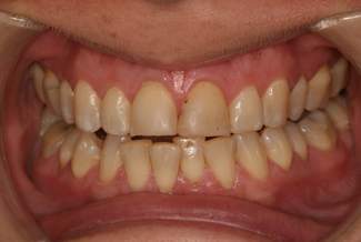 veneers_london_before