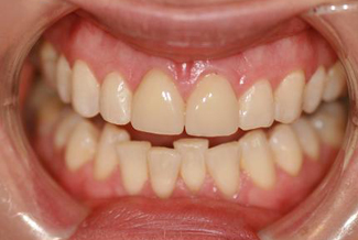veneers_london_after