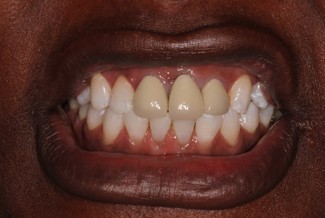 Treatment for Dental Crowns in London Before