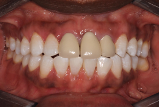 Treatment for Dental Crowns Before