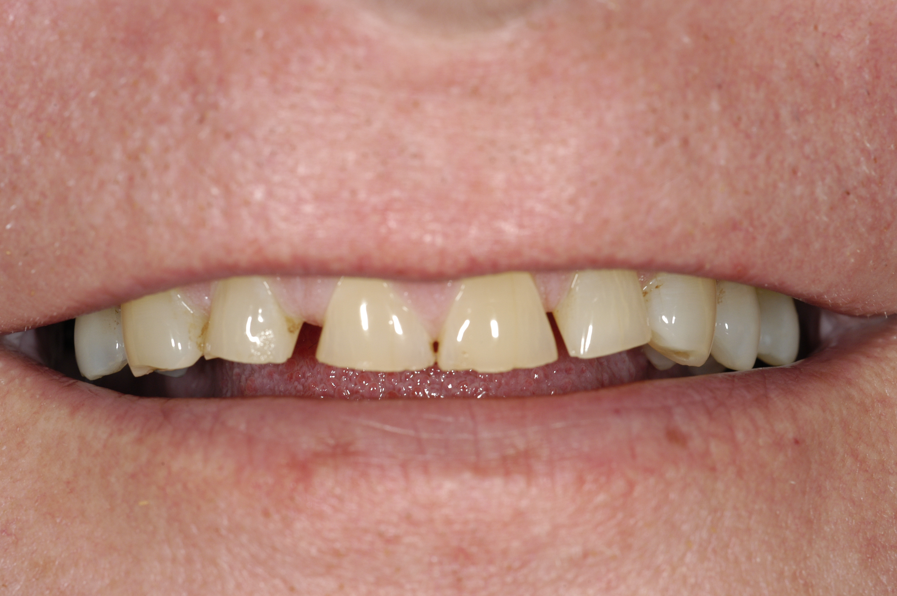 Composite Veneers London Before