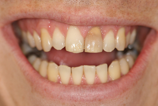 veneers_london_before