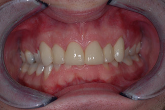 veneers_london_after