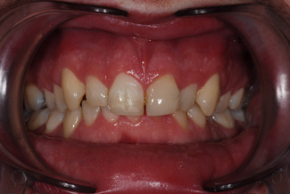 veneers_london_before