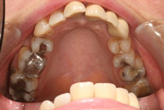 Before Dental Crowns Treatment London