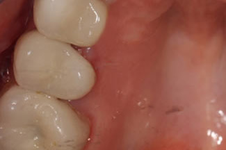 Dental Crowns London After