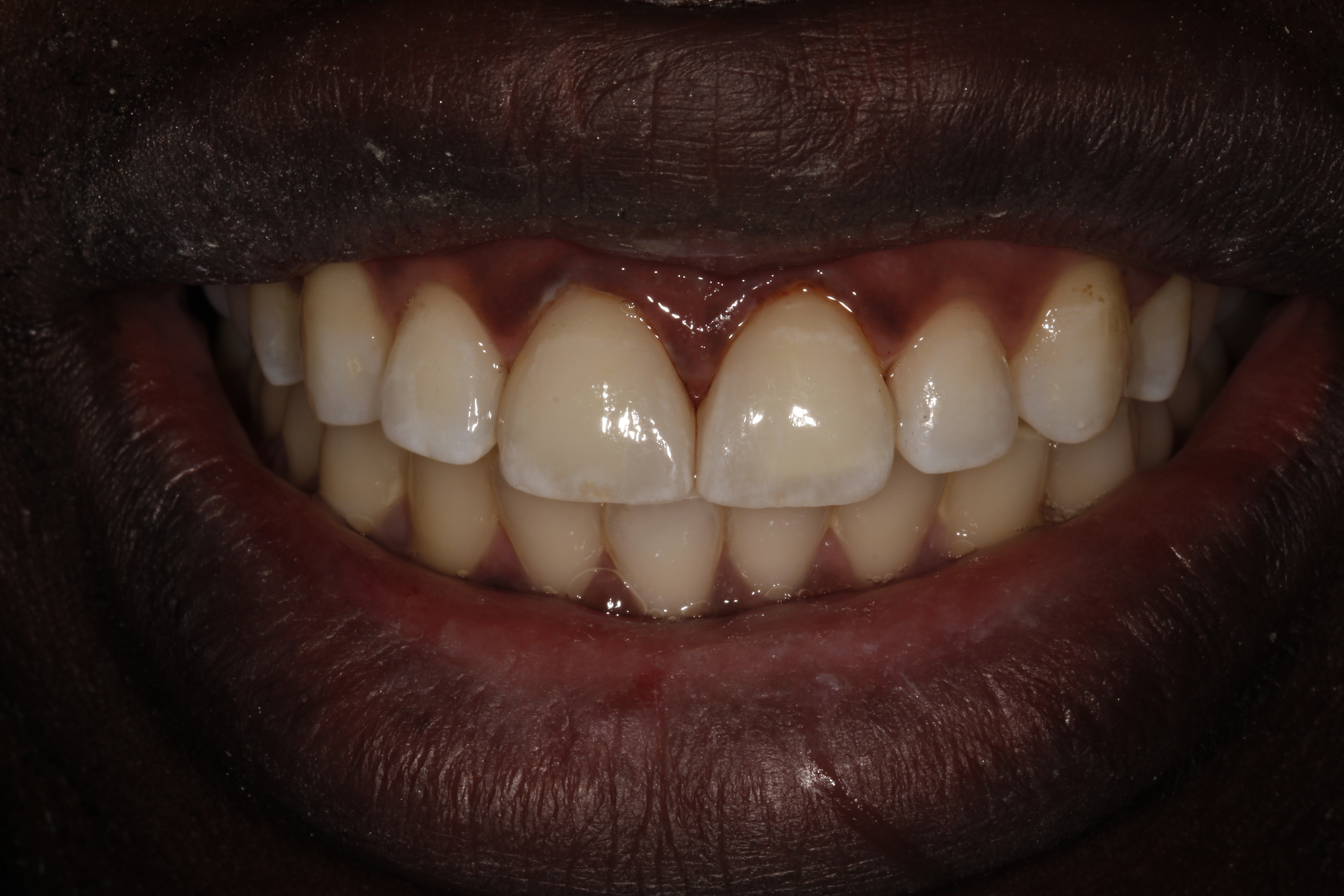 Porcelain Veneers London Dentist 