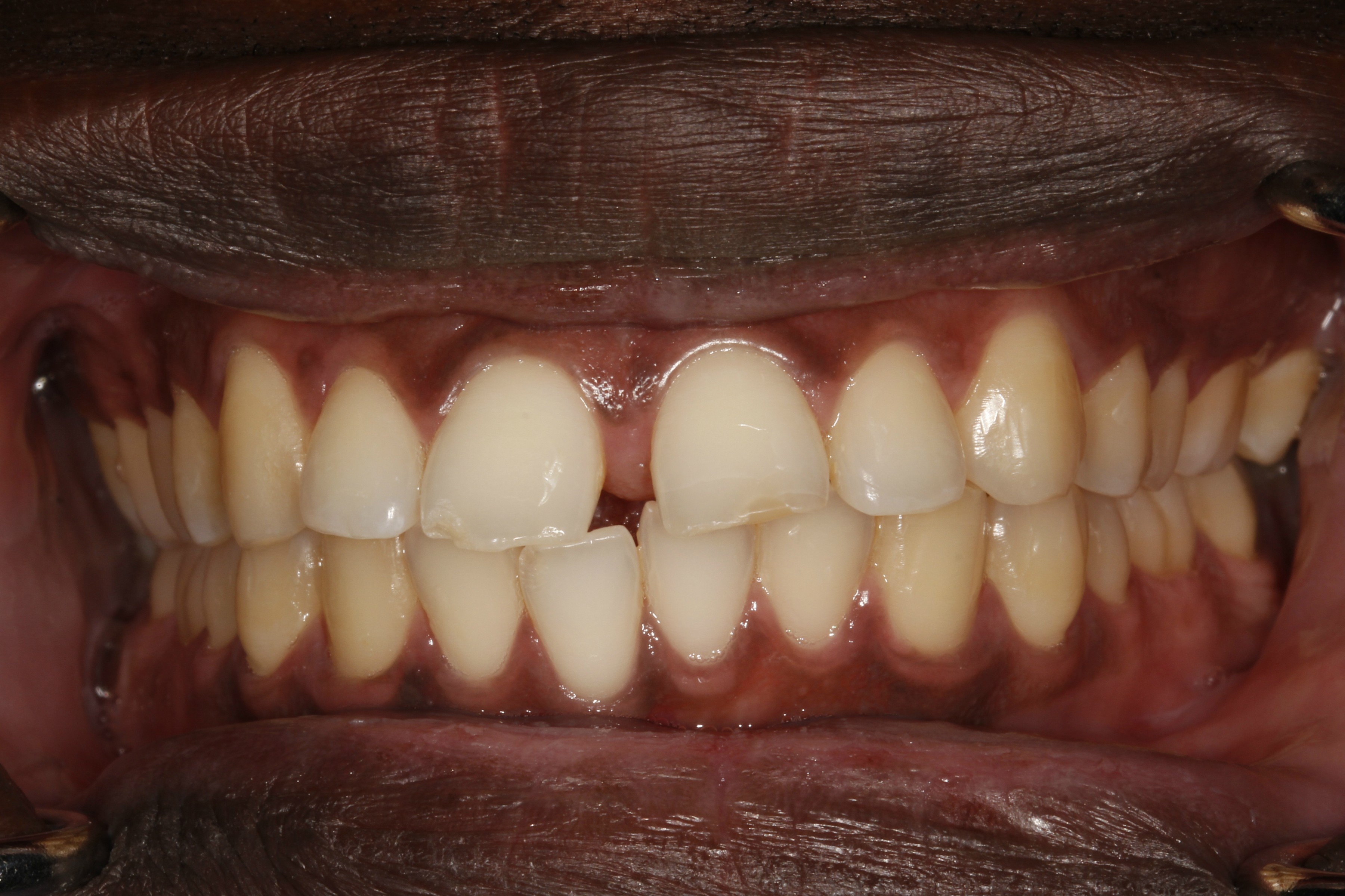 Porcelain Veneers London Dentist 