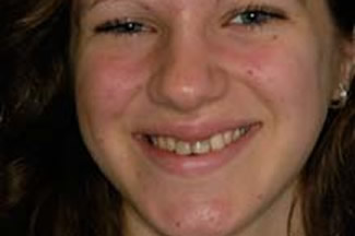 Dental Crown Treatment Before