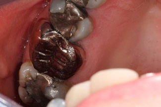 Dental Crowns London Before