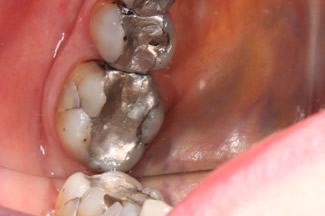 Mercury Removal Before