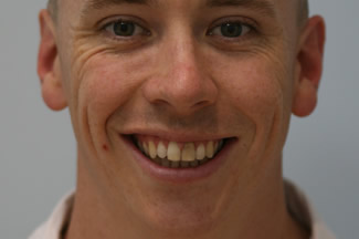 veneers_london_before