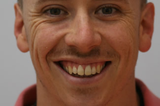 veneers_london_after