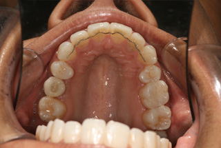 Invisalign – Invisible Braces After
