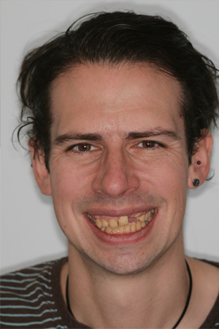 Dental Implants London Dentist Before