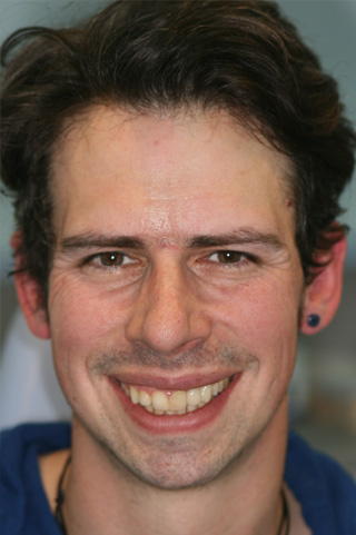 Dental Implants London Dentist After