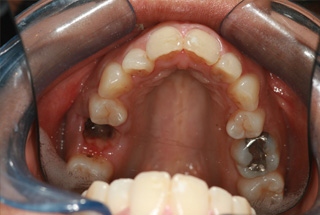 Invisalign – Invisible Braces Before