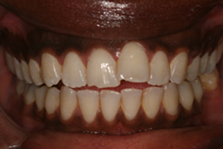 Inman Aligners Teeth Before