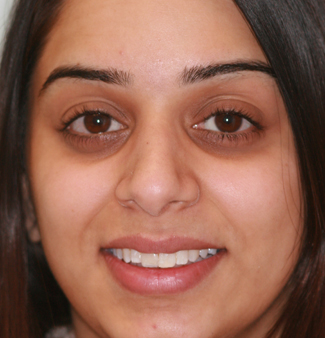 Inman Aligners in London - Teeth After