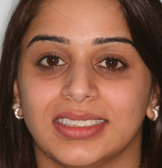 Inman Aligners in London - Teeth Before