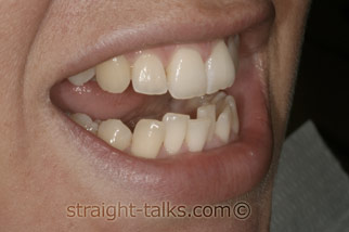 Inman Aligners in North London - Teeth Before