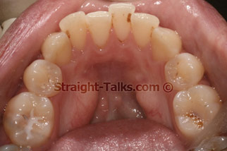 Inman Aligners with Smile Cliniq - Teeth Before