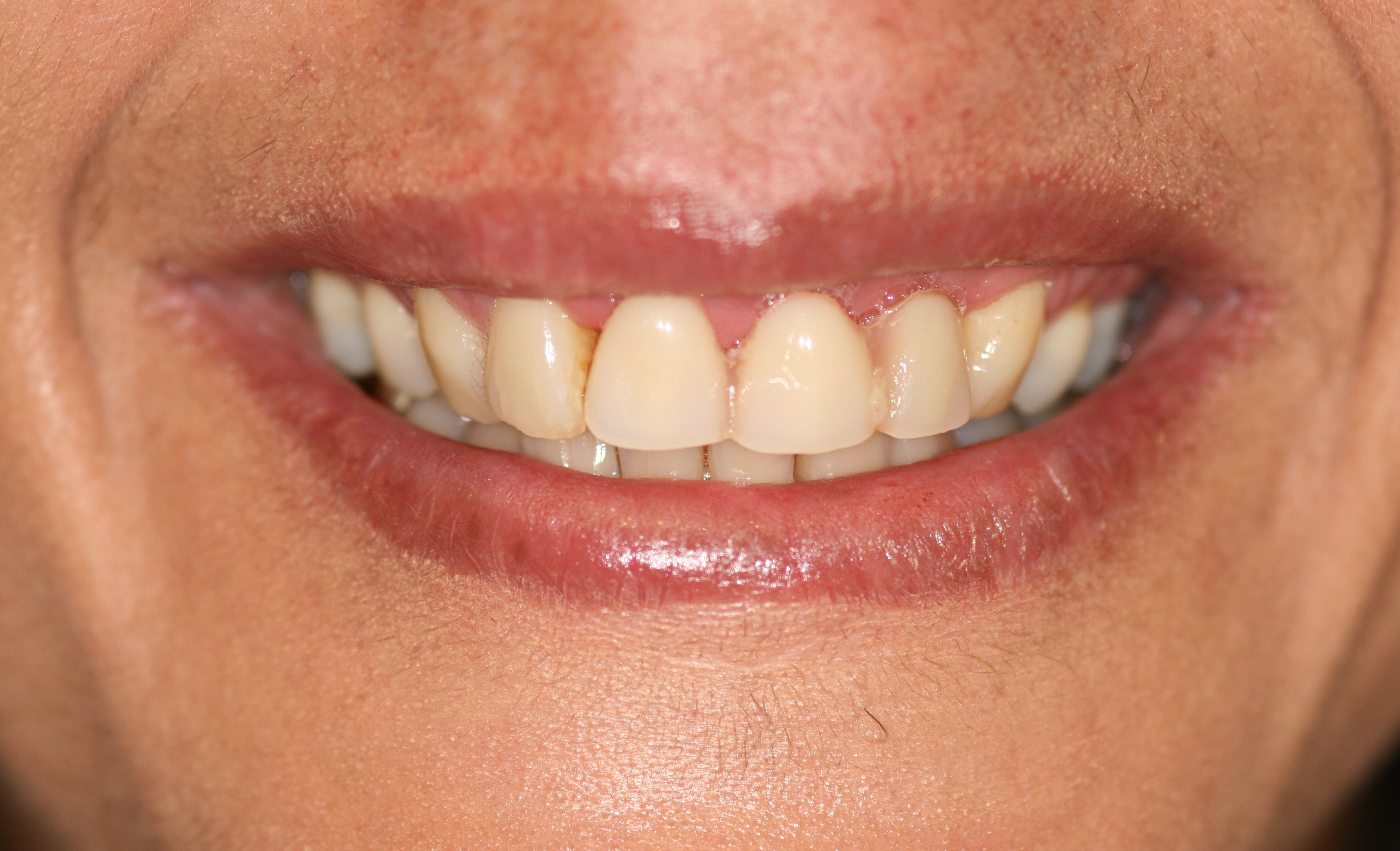 Dental implants London After