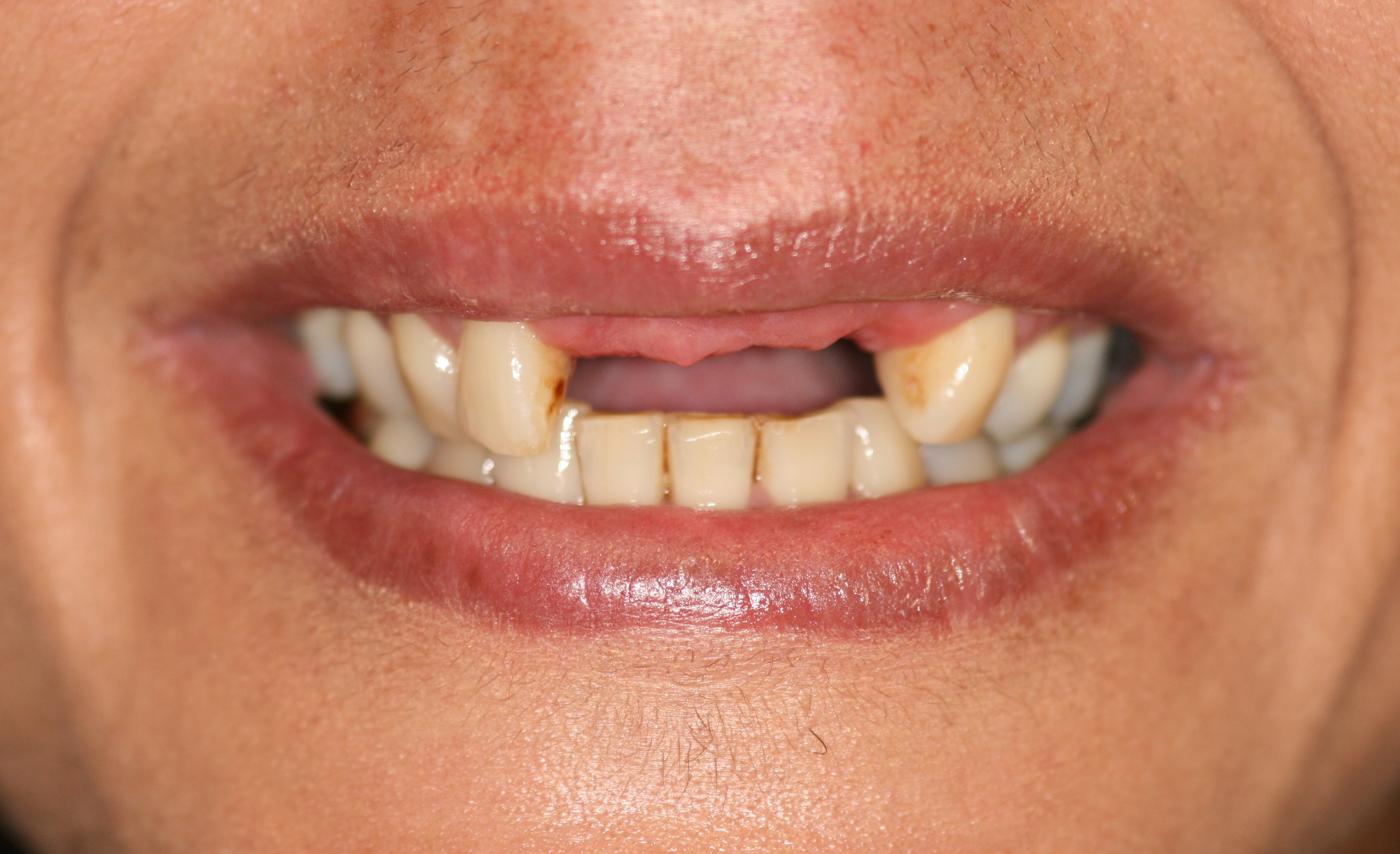 Dental implants London Before