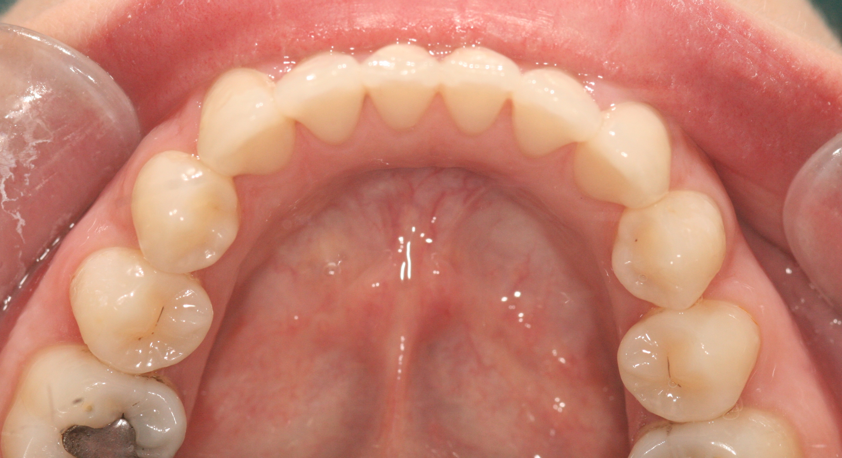 London Dentist Invisalign After