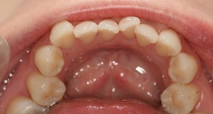 London Dentist Invisalign Before