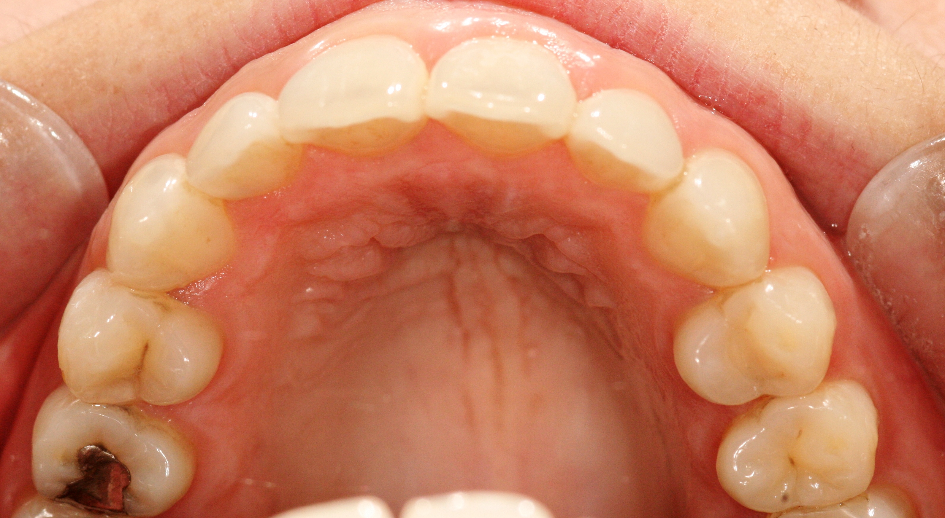 London Dentist Invisalign Braces After