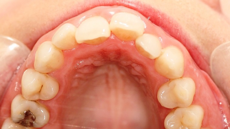 London Dentist Invisalign Braces Before