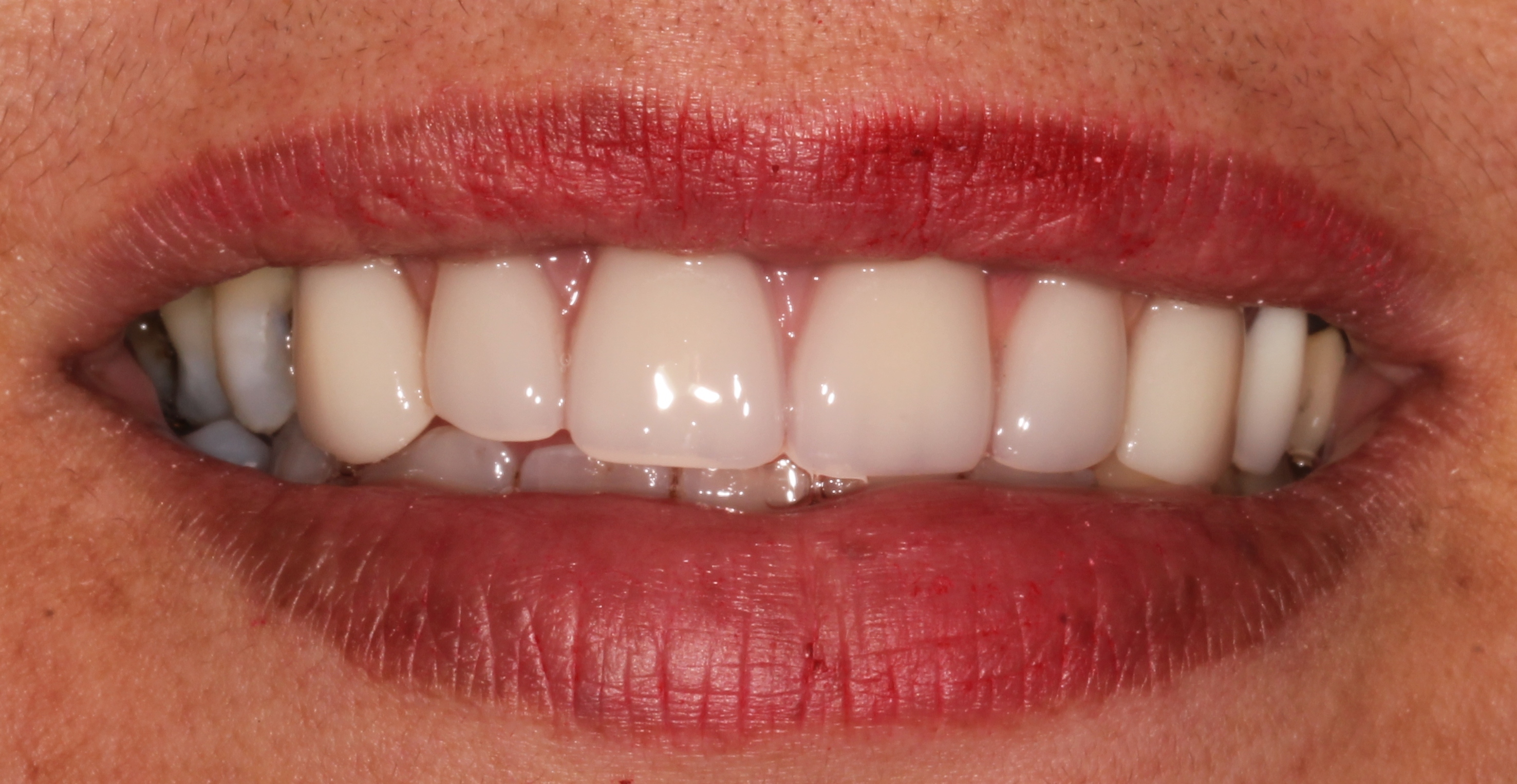Dental Implants After