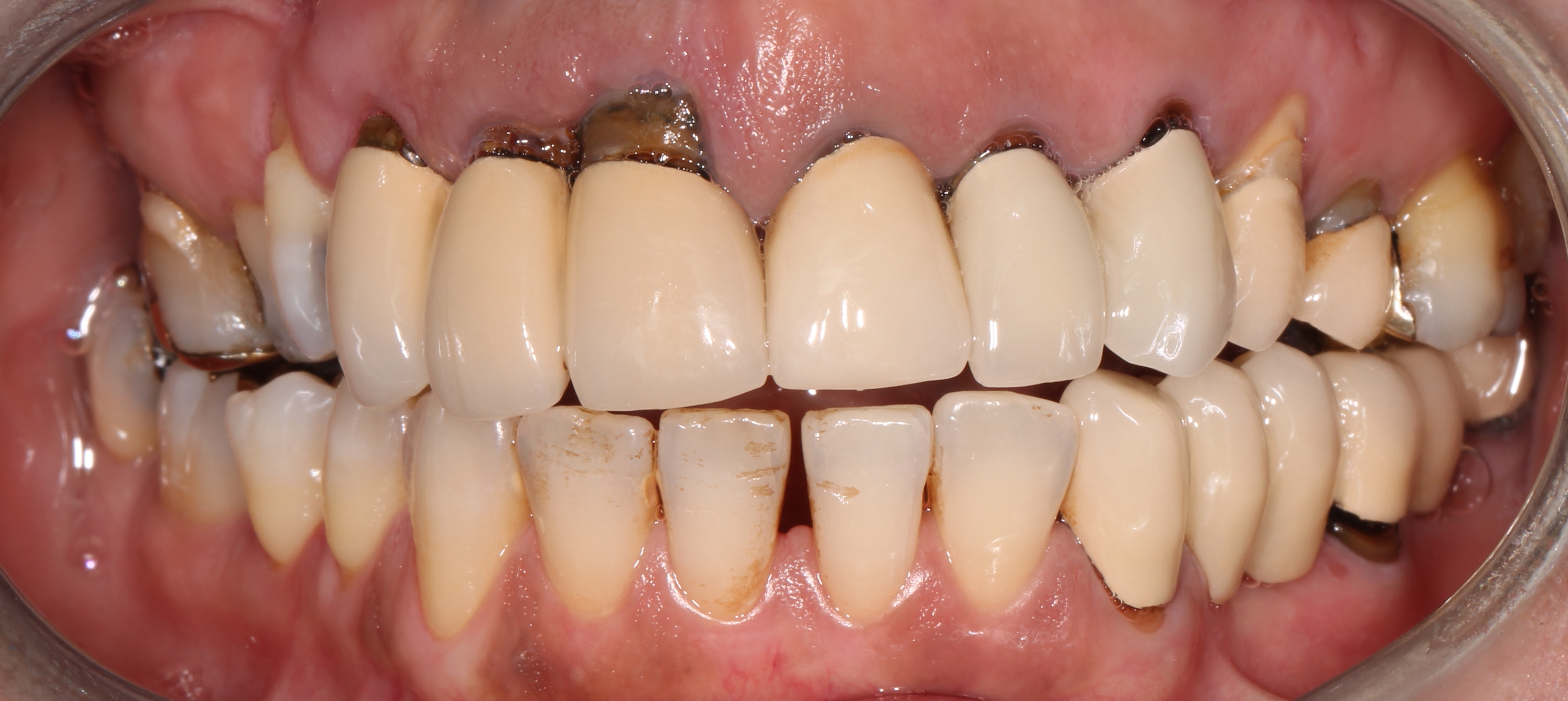 Dental Implants Before
