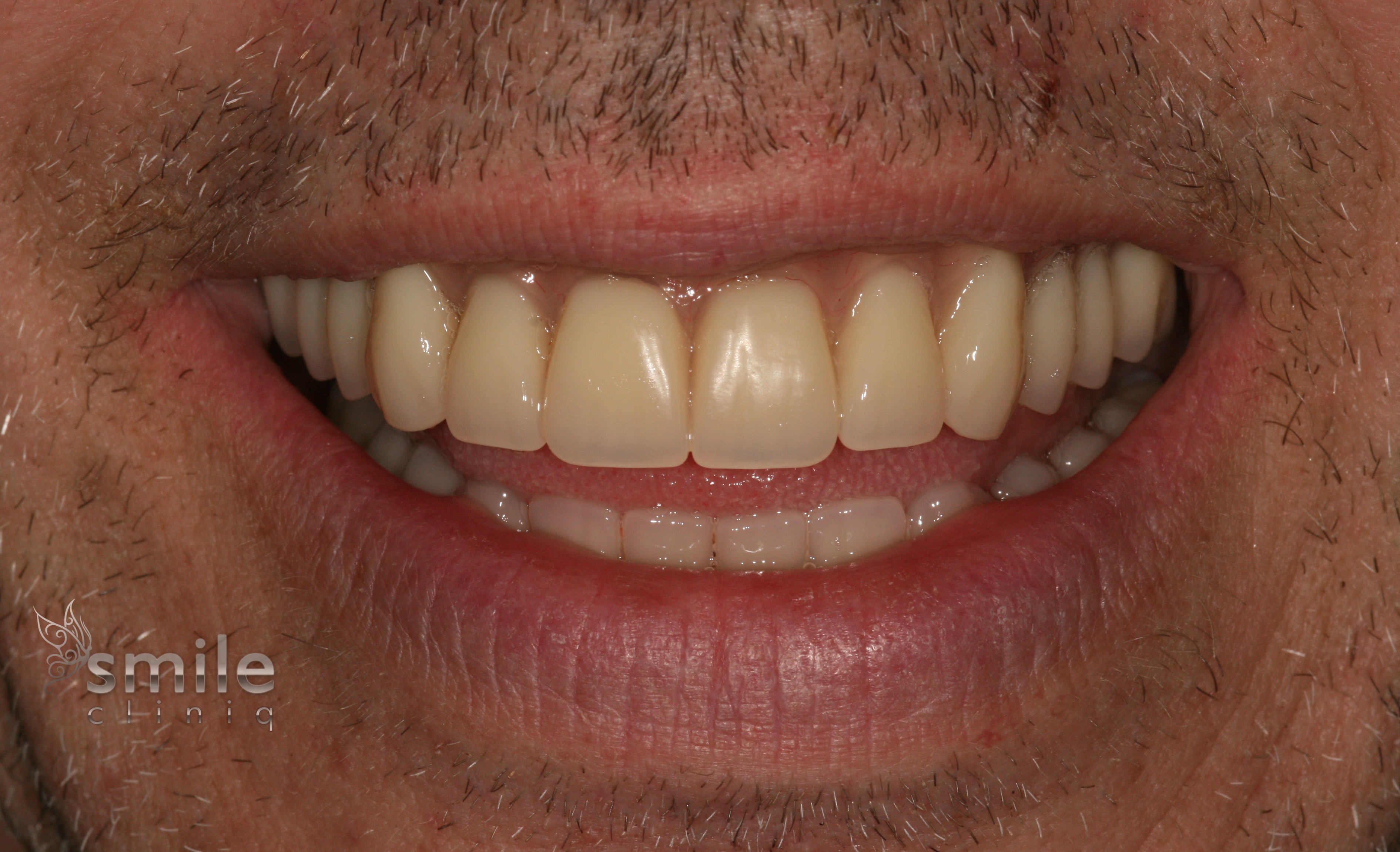 Teeth in a day London after