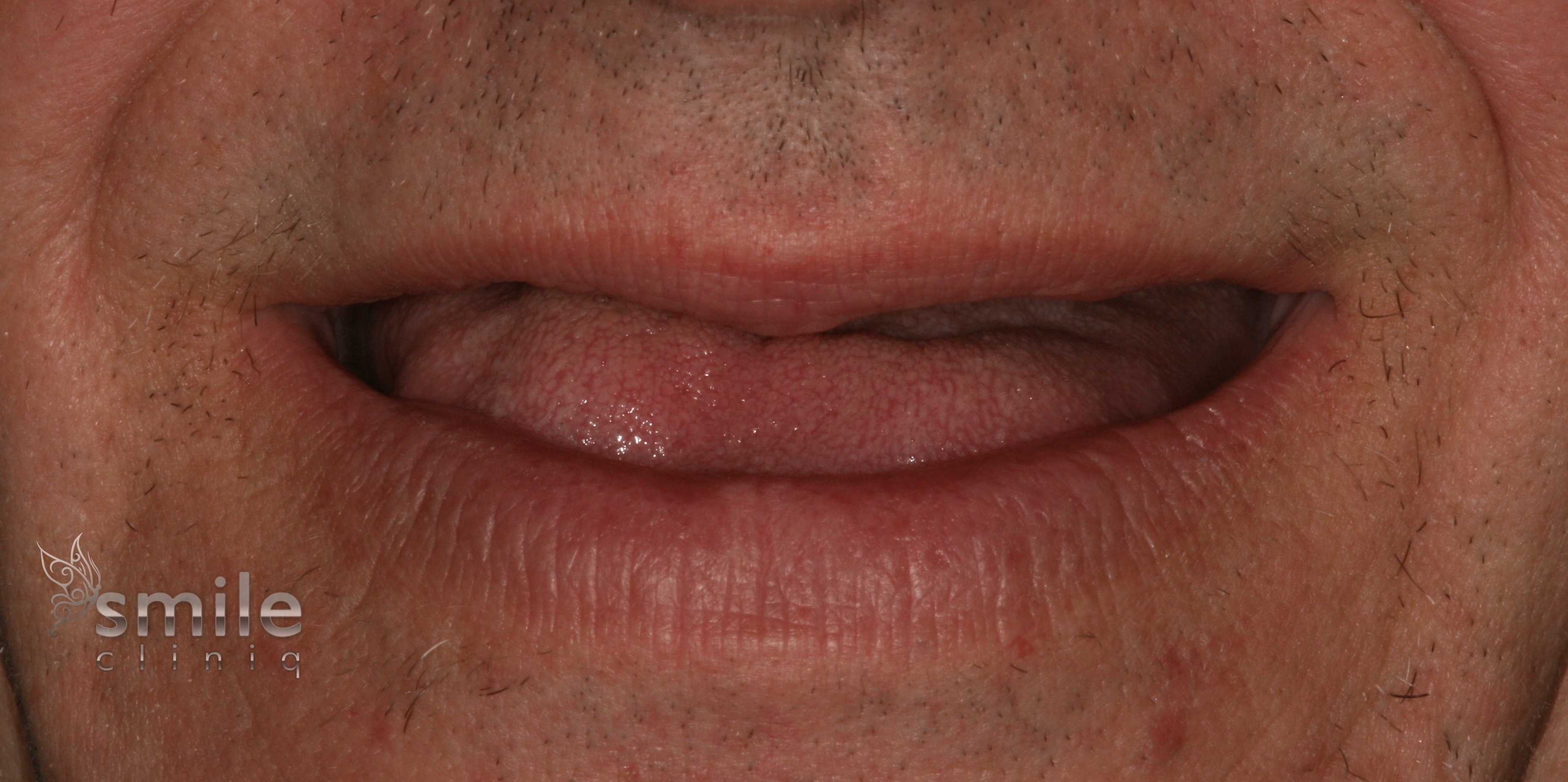 Teeth in a day London before