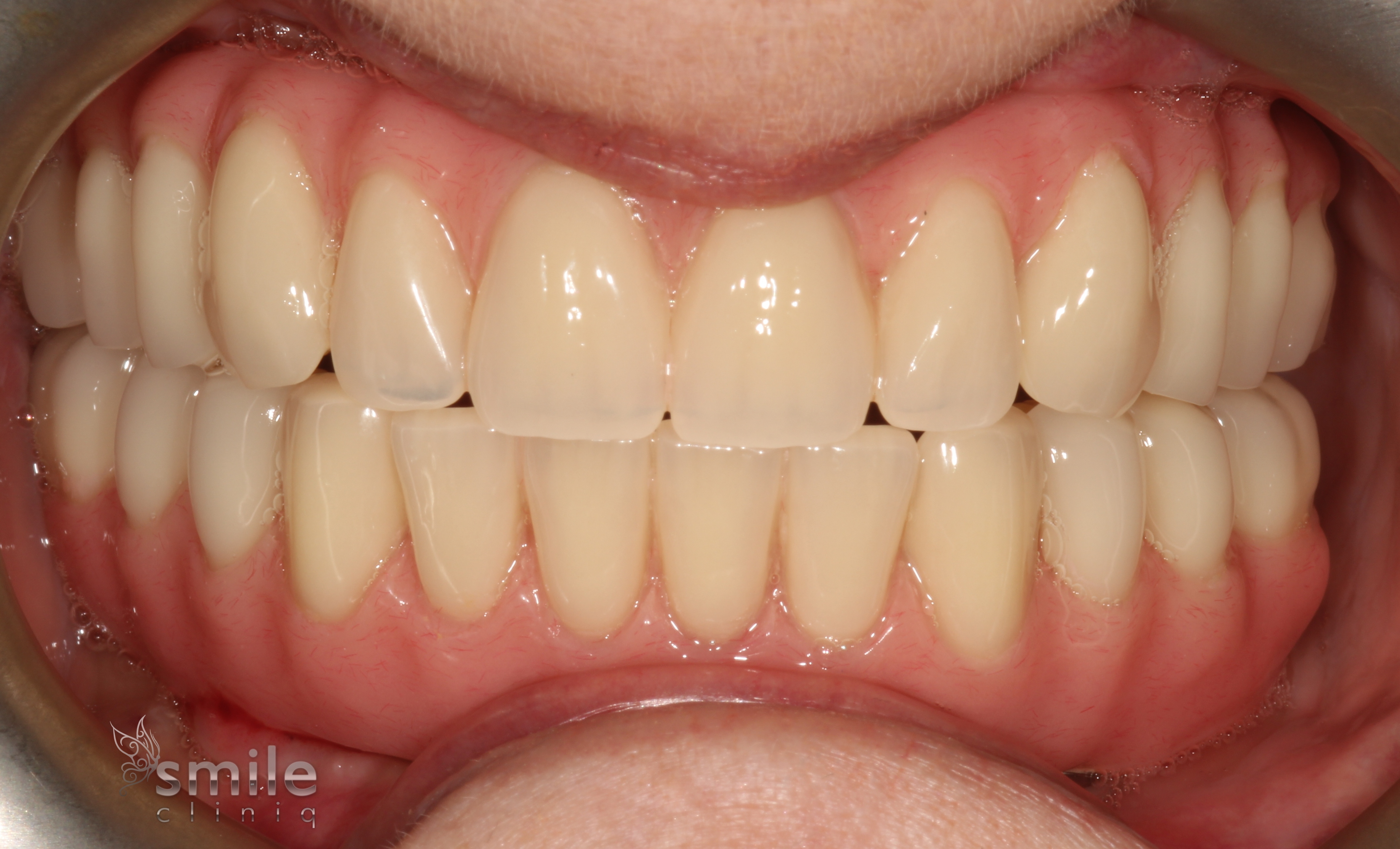 Same Day Implants London 