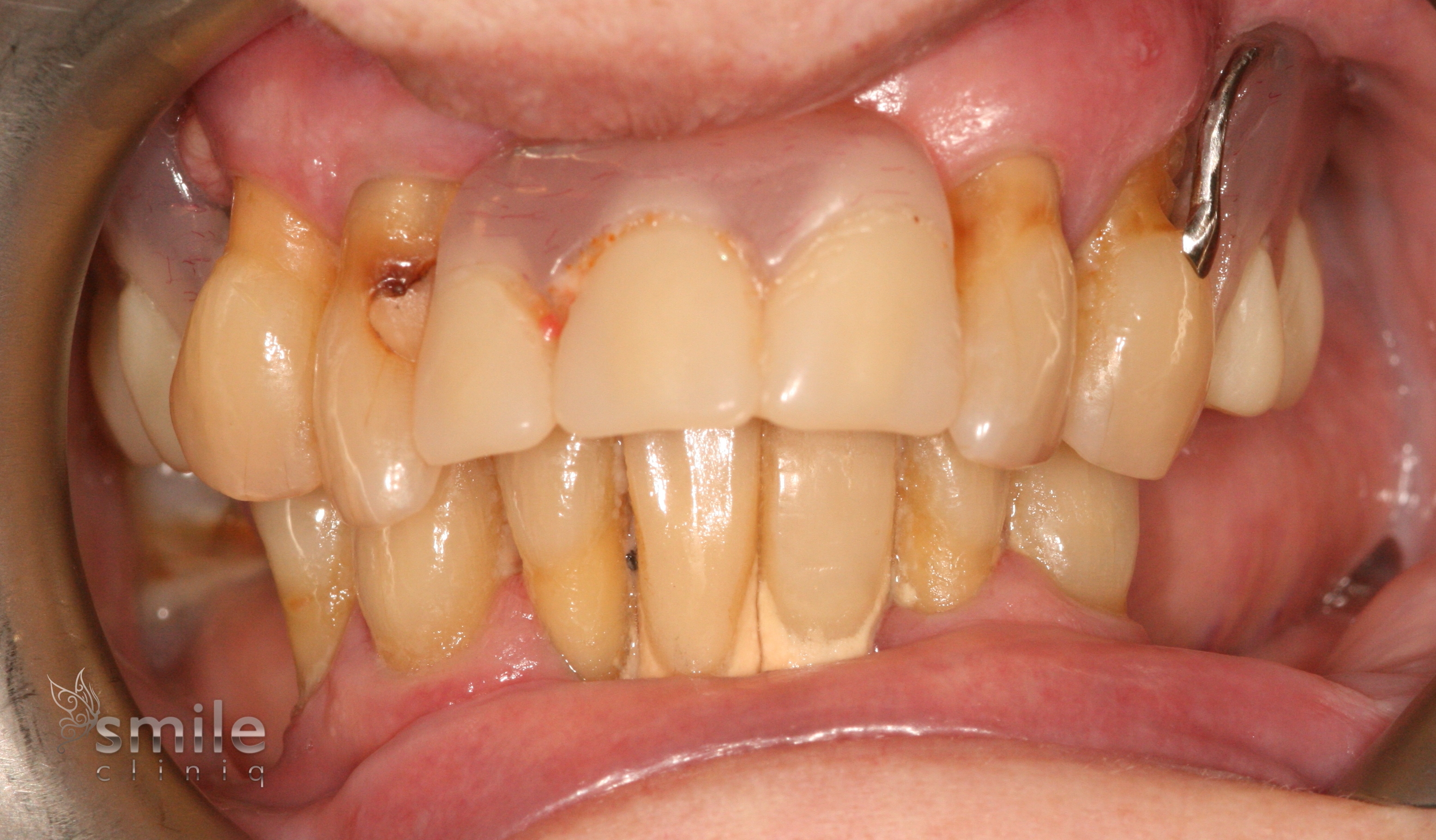 Same Day Implants London 