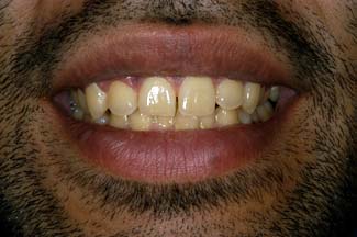 Tooth Whitening in London Before