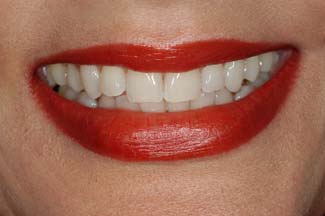 Teeth Bleaching After