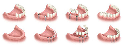 Dental implants graphic